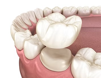 Dental Crowns in Rochester, NY