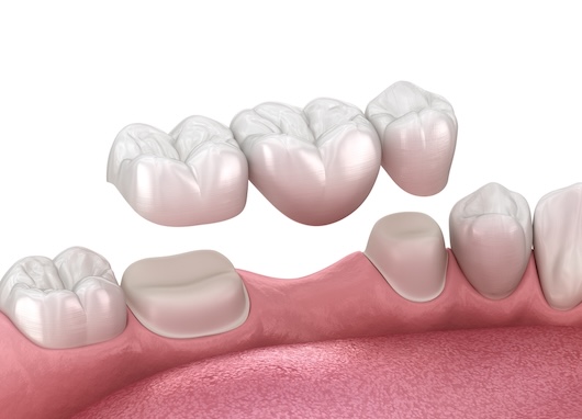 Dental Bridge in Rochester, NY
