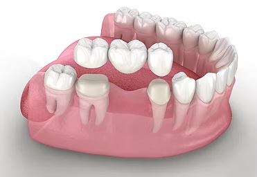 Dental Bridge in Rochester, NY
