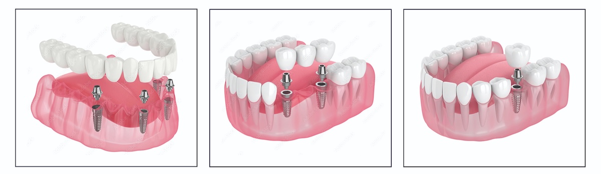 Dental implant services