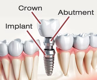 Dental implants in Rochester, NY