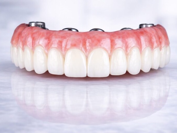 Full-Arch Dental Implants