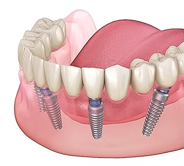 Full-Arch Dental Implants in Rochester, NY