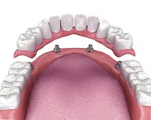 Implant-supported lower dentures