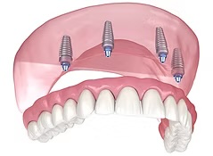 Implant-Supported Complete Upper Dentures