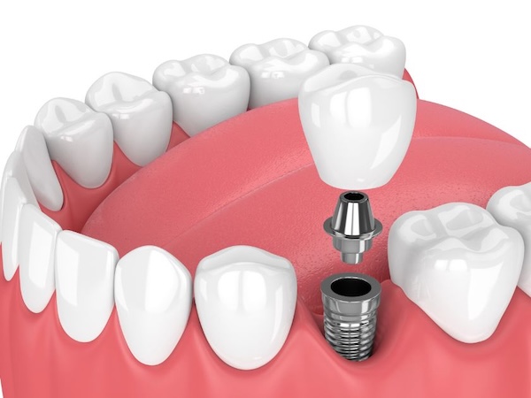 Implant-Supported Crown