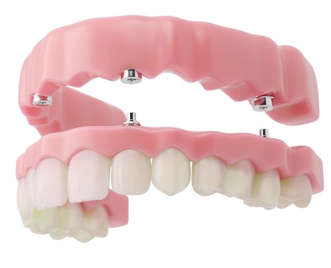 Implant-Supported Dentures in Rochester, NY