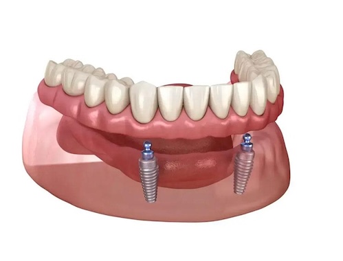 Overdentures in Rochester, NY